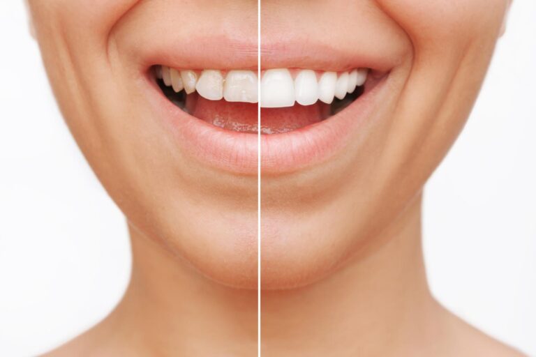 Cropped shot of a young caucasian smiling woman before and after veneers are installed isolated on a white background. Teeth whitening. Dentistry, dental treatment. The result of veneers installation.