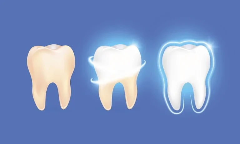 Is Professional Teeth Whitening Safe?
